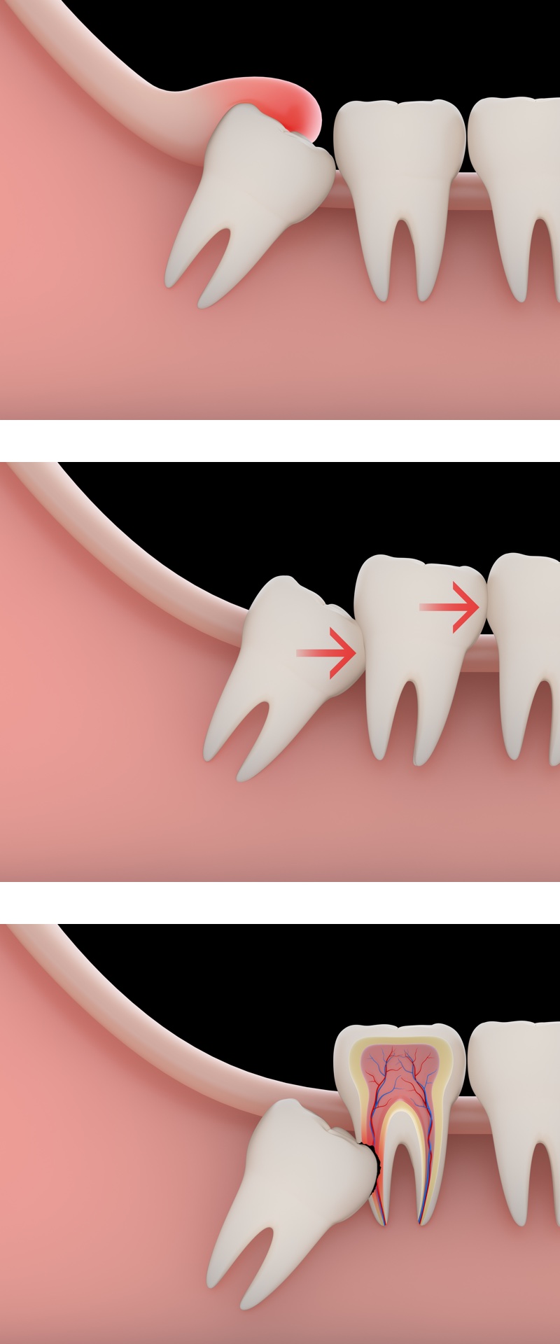 wisdom teeth before and after