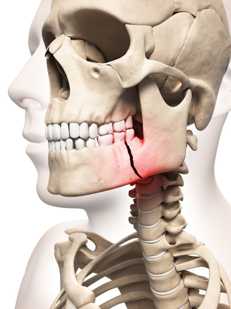 FACIAL TRAUMA Aspen Oral and Facial Surgery