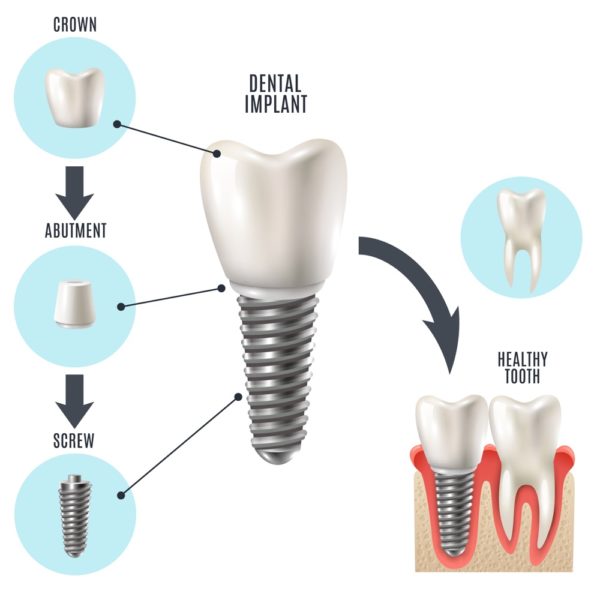 Dental Implant 1