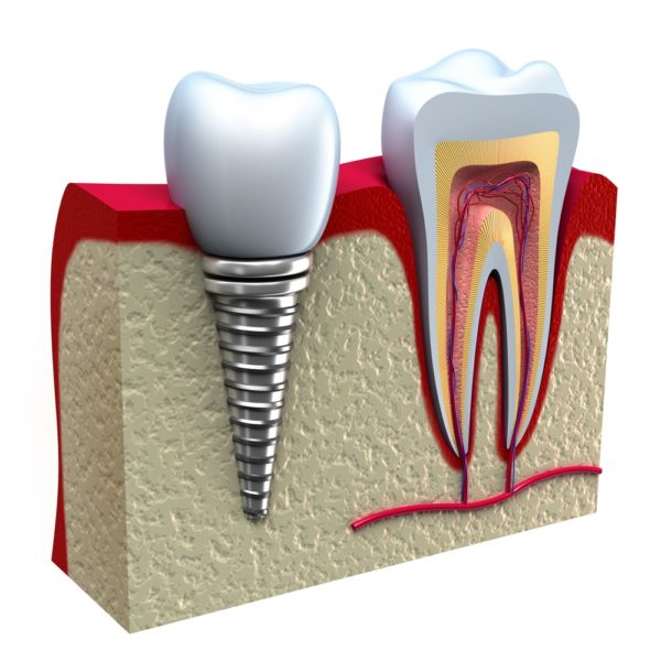 Dental Implant 2